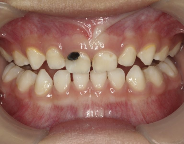  caries treatment primary teeth