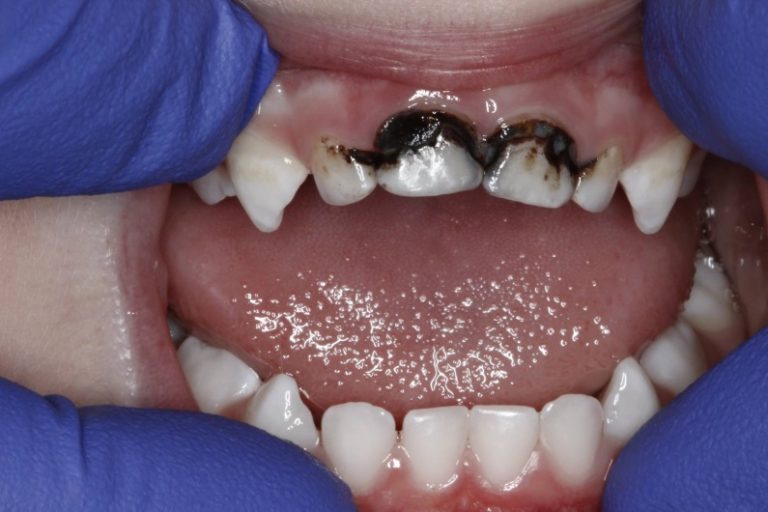 SDFSilver Diamine Fluoride in Oak Harbor & Anacortes, WA Playhouse